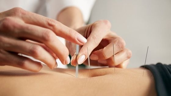 0Agujas de acupuntura intradérmica de plata para aliviar el dolor.